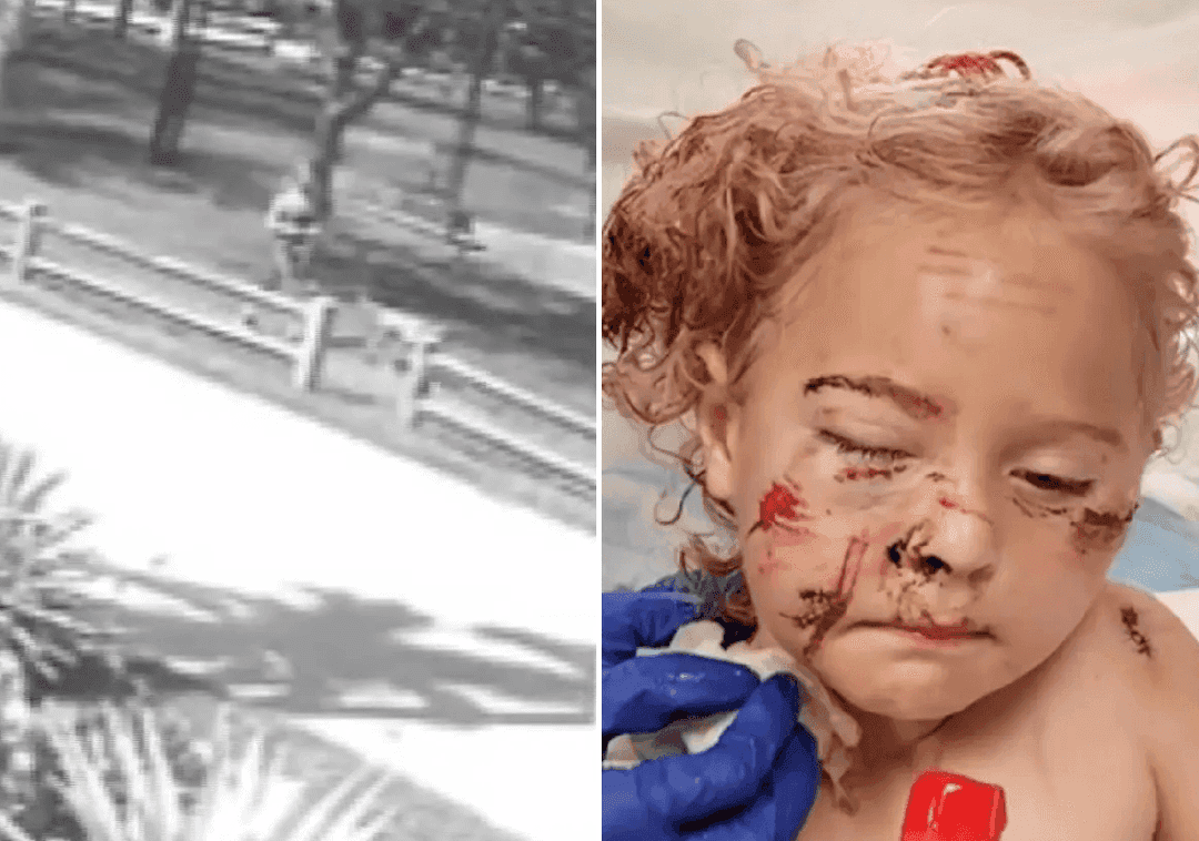 פלורידה: 50 תפרים לילדה בת 5 שהותקפה באכזריות על ידי כלב 