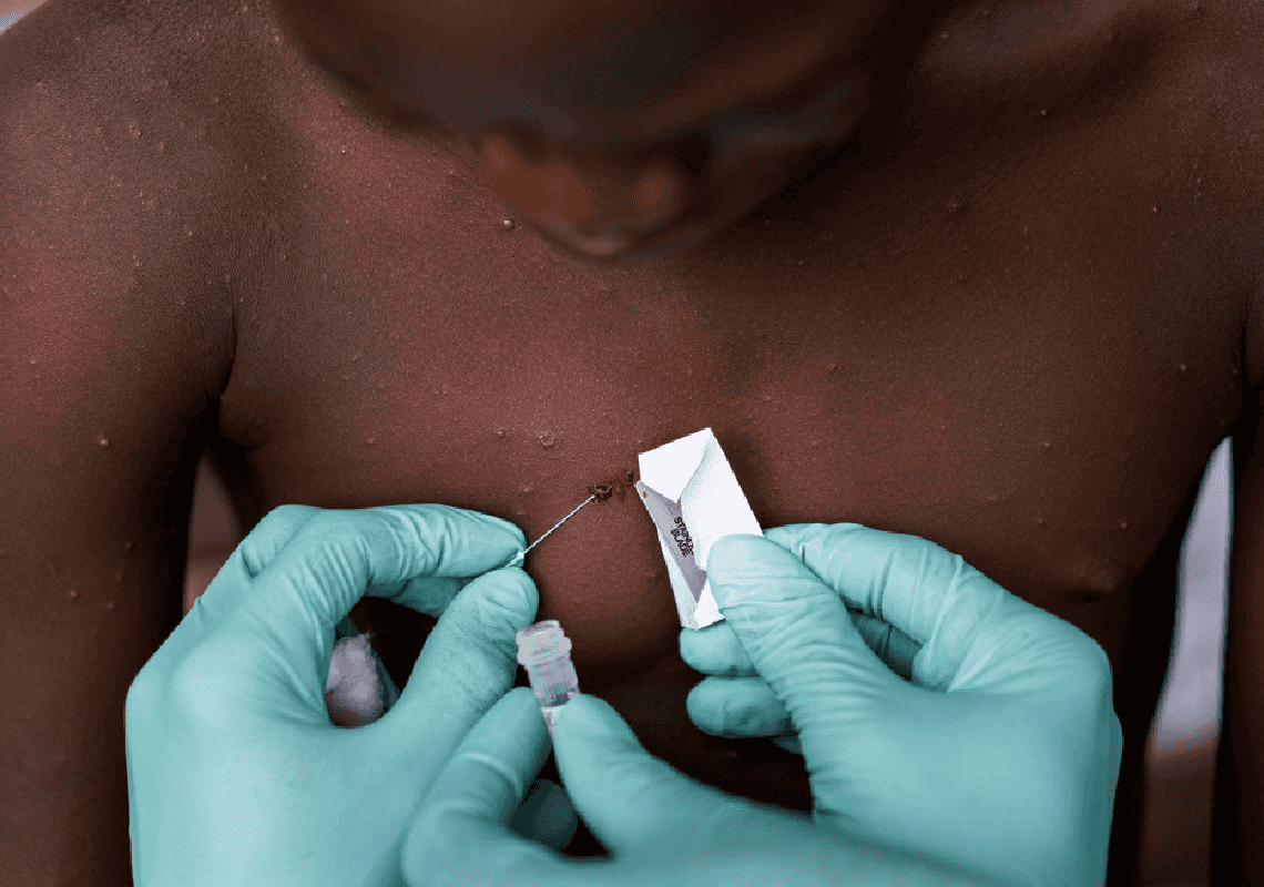 ה-CDC עוקב אחר מאות אנשים ברחבי ארה"ב שבאו במגע עם חולה ב"אבעבועות הקוף"