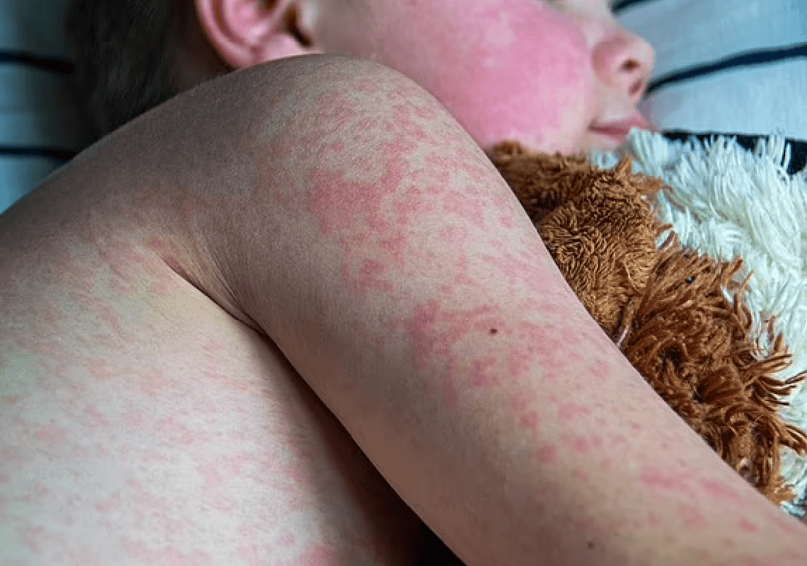 מקרה מוות ראשון בהתפרצות החצבת בטקסס: ילד צעיר נכנע למחלה