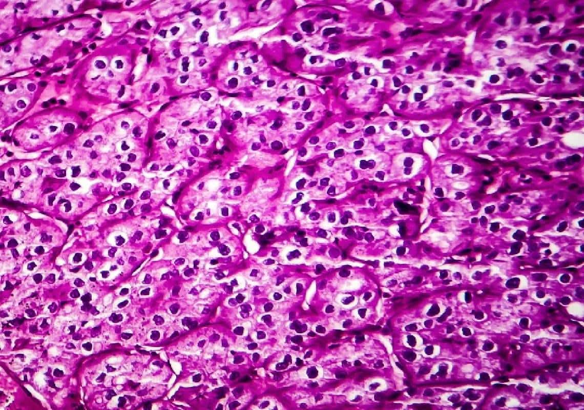 הישג מדעי: פריצת דרך תרופתית בטיפול בסרטן הכליות - "זמן השרידות כמעט כפול עתה מהממוצע"