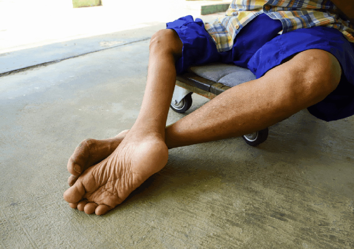 אחרי עשרות שנים: נגיף הפוליו זוהה בבריטניה 