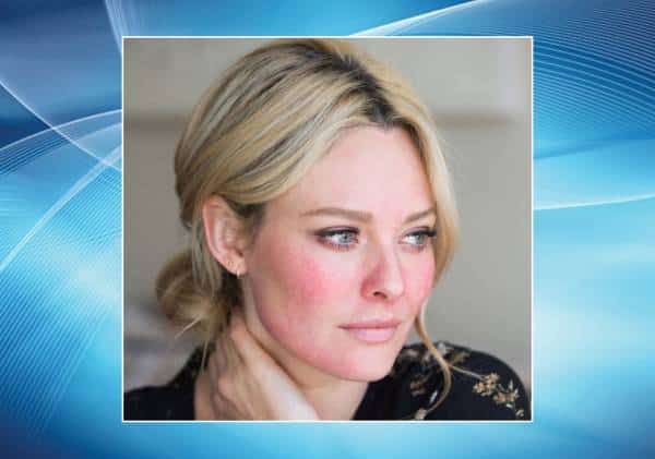 הוכח קשר הדוק בין "האקנה של המבוגרים"  לבין קשיי שינה משמעותיים