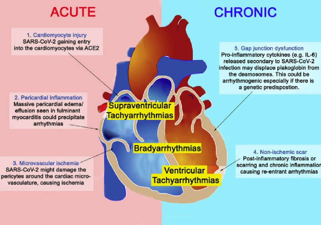 דרמטי: ‏פייזר ומודרנה יחלו בניסויים לבדוק את הקשר בין החיסונים לדלקת שריר הלב