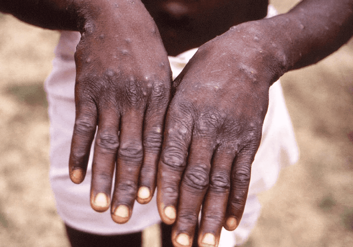 התפרצות אבעבועות הקוף: ארגון הבריאות העולמי הודיע על שינוי שם הנגיף בטענה שהוא "סטיגמטי"