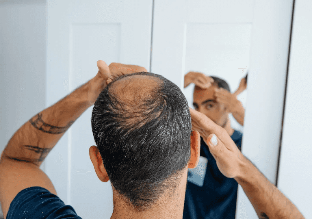 תרופה מהפכנית להתקרחות? הניסוי הקליני יוצא לדרך