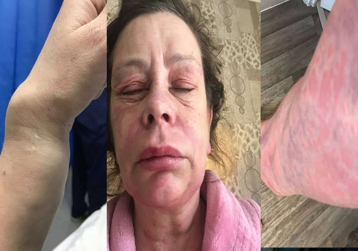 "אני מרגישה כמו חייזר או מפלצת": העור שלה החל לבעבע בעקבות קבלת חיסון אסטראזנקה