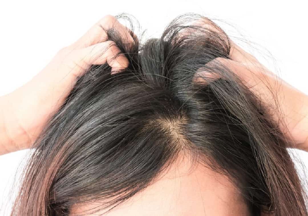 סובלים מיובש בקרקפת? כך תטפלו 