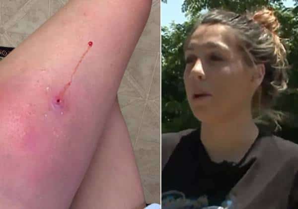 אימה במהלך בילוי בים: צעירה נכנס למים והותקפה על ידי חיידק אלים