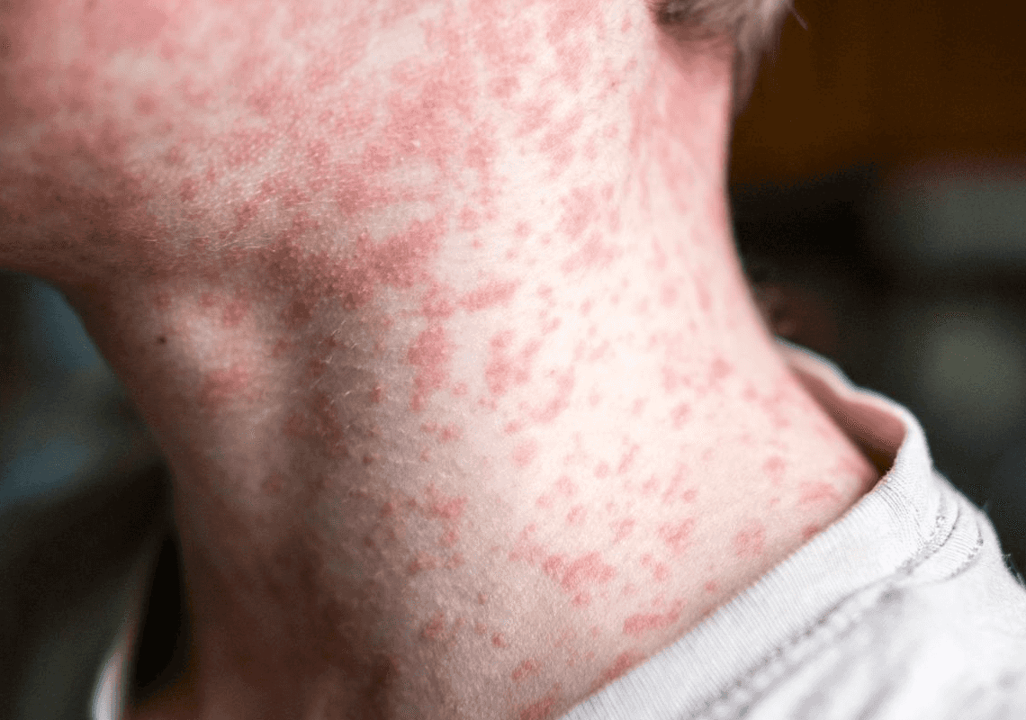 התפרצות חצבת מדאיגה בטקסס - במחוז עם שיעורי חיסון נמוכים מהרגיל