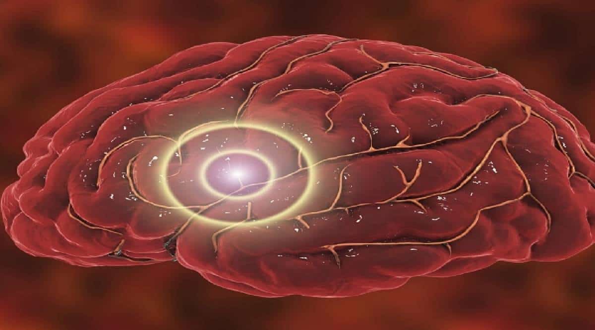 טכניקה כירורגית ותיקה עשויה להציל משבץ מוחי 