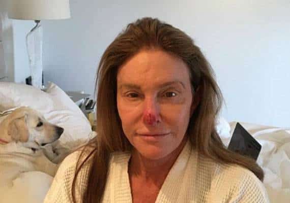 קייטלין, למה האף שלך כל כך אדום? כך מנסה ג'נר ללמד אותנו להתגונן מהשמש