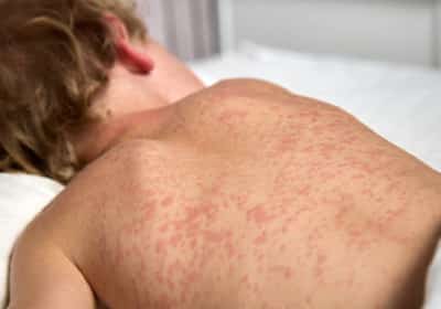 החצבת מכה בארה"ב: התפרצות הקשה ביותר מאז מיגור המחלה בשנת 2000