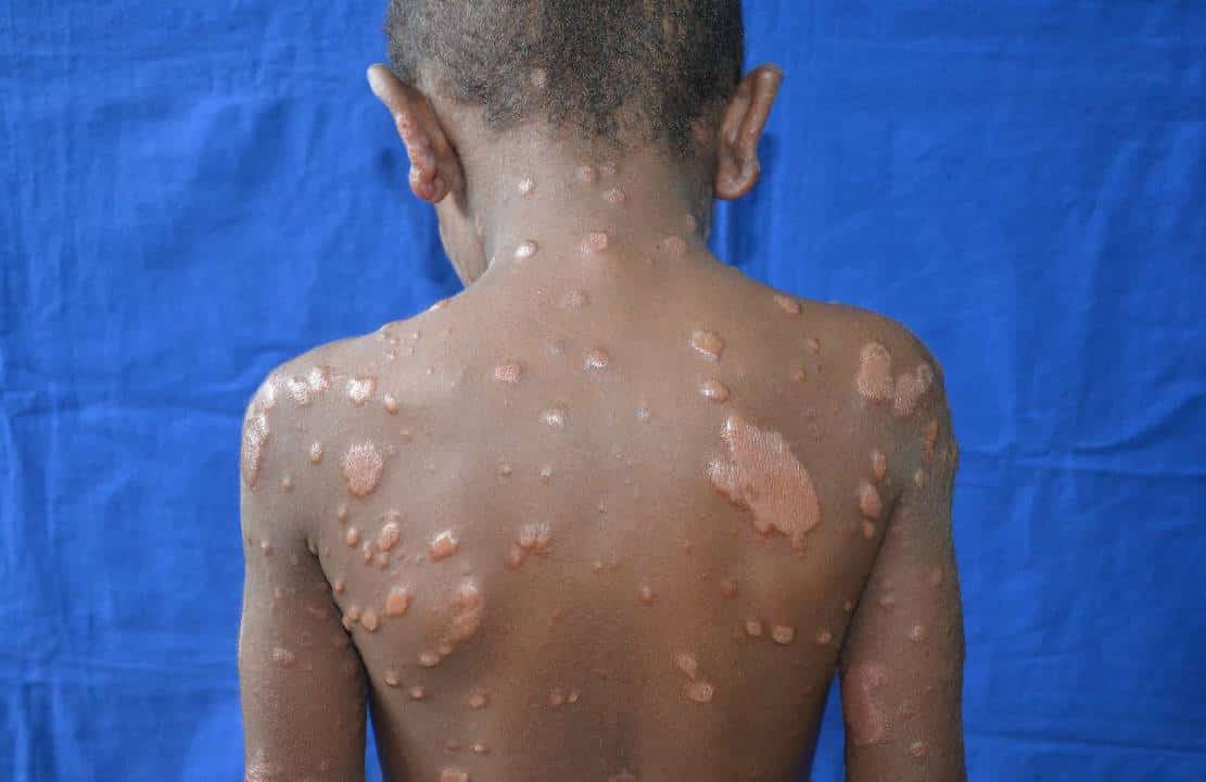 פלורידה הופכת למוקד של מחלה תנ"כית עתיקת יומין