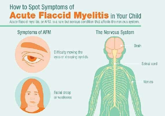 פלורידה: אושר מקרה ראשון של מחלת AFM, הדומה לפוליו