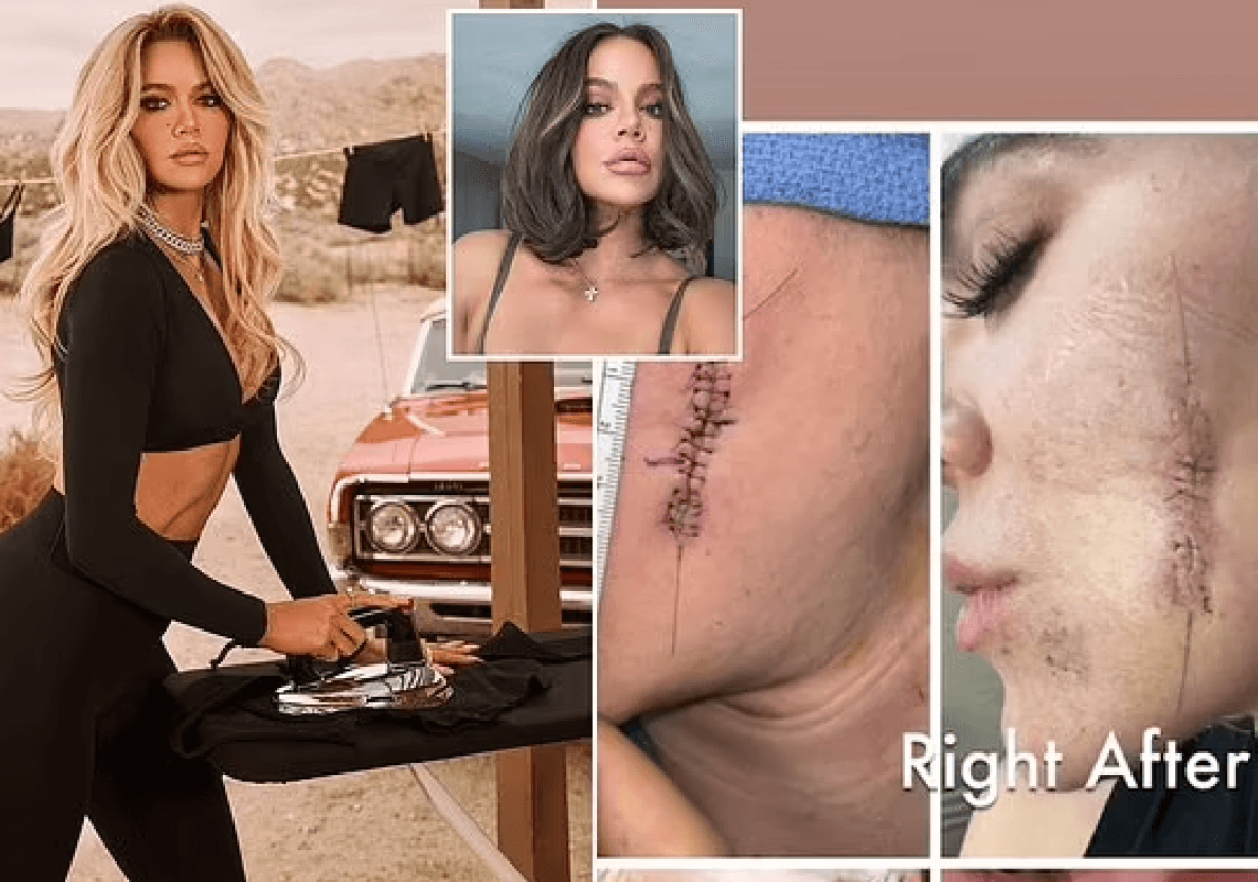 קלואי קרדשיאן משתפת תיעוד מתהליך ההחלמה מסרטן העור