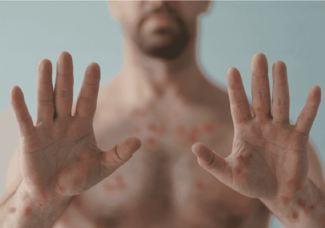 התפשטות אבעבועות הקופים: מקרה מוות ראשון בארצות הברית 