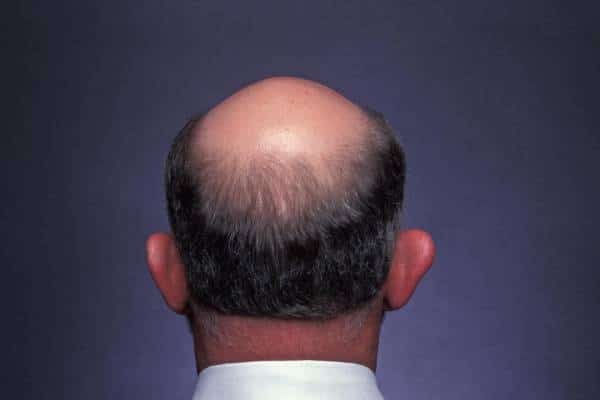 חלומו של כל גבר מקריח: האם נמצאה התרופה לפתרון בעיית ההתקרחות עתיקת היומין? 