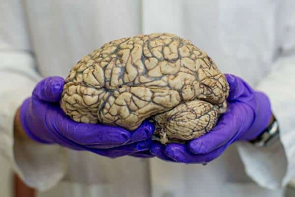 תקווה חדשה: ניסוי בתרופה נגד אלצהיימר מציג תוצאות מבטיחות 