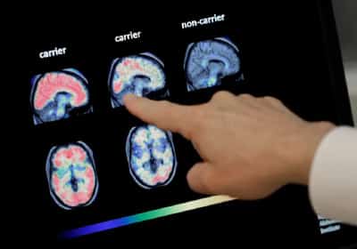 חוקרים קובעים: הרגל יומי שמקטין באופן משמעותי את הסיכון לאלצהיימר