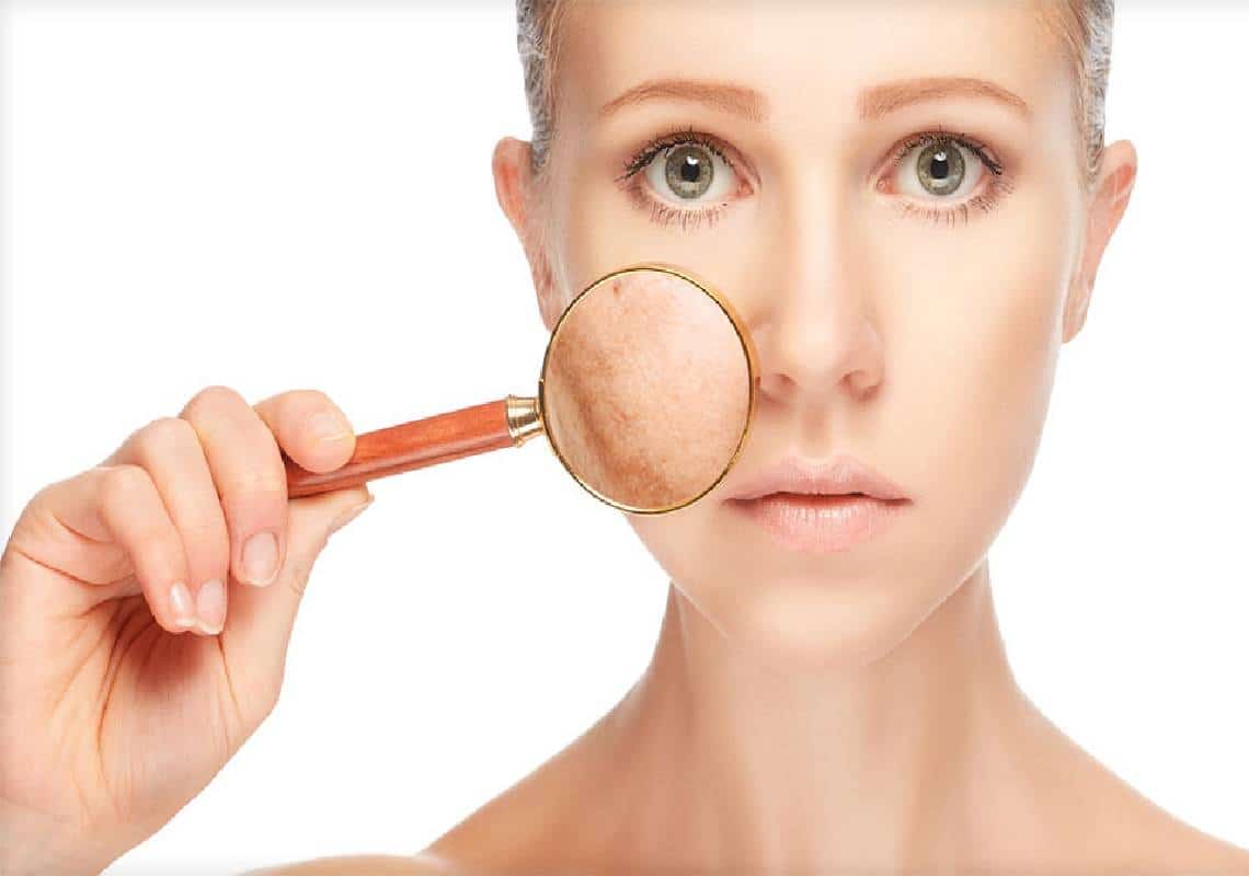 סובלים מפיגמנטציה? החורף הוא הזמן המושלם לטפל בבעיה: הנה 5 דרכים אפקטיביות ומהירות