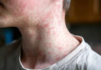 מקרה נוסף של חצבת בלוס אנג'לס: הרשויות פרסמו את מסלול החשיפה מ-LAX ועד הוואלי