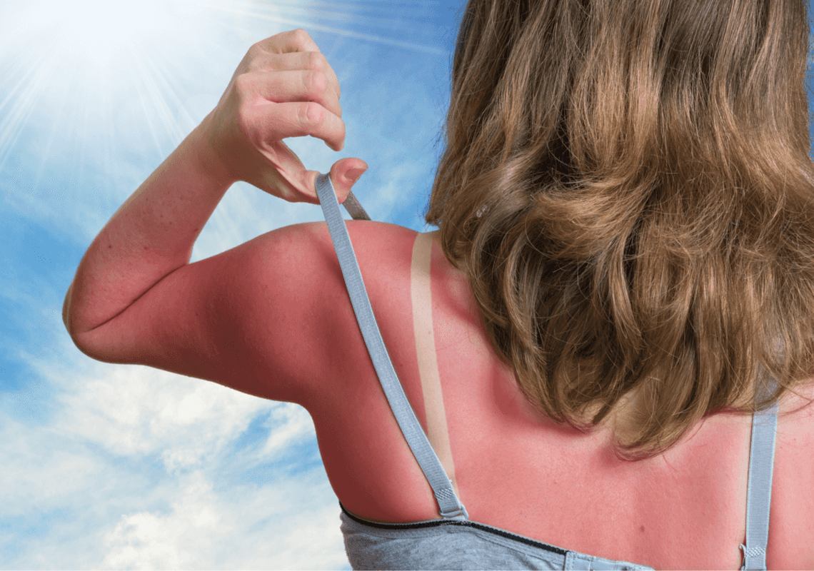 כווית שמש רגילה או הרעלת שמש חריפה: איך לזהות וחשוב יותר, איך לטפל?