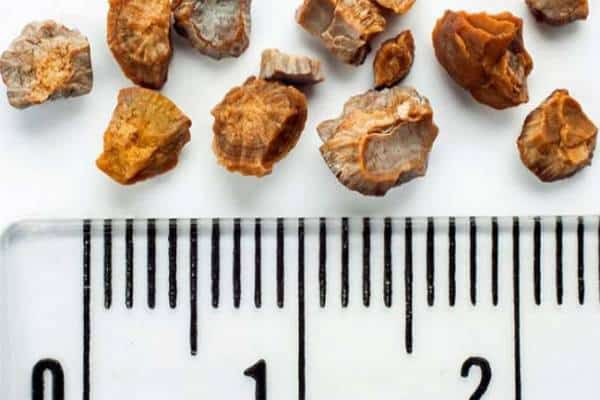 תזרקו אבנים: לא כדאי לכם לצבור אותן בכליות