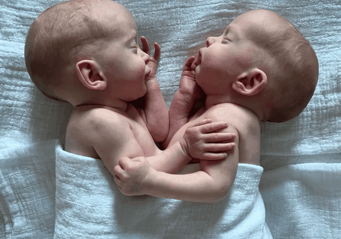 אחרי 4 שעות בחדר הניתוח: נקבע גורלן של התאומות הסיאמיות