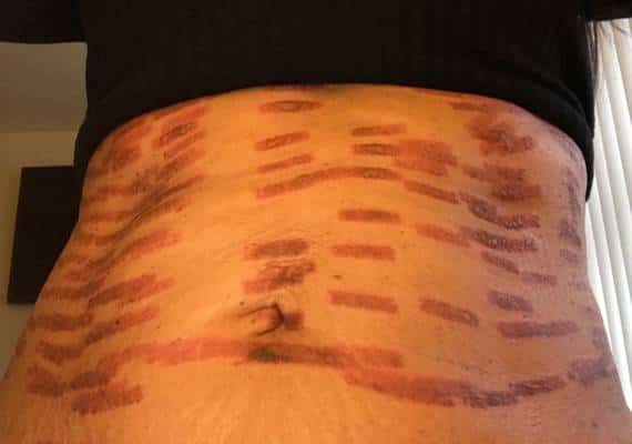 לונג איילנד: ביקשה לעבור טיפול בלייזר וספגה כוויות בכל הגוף