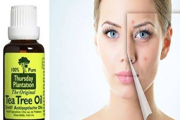 תשאירו את החצ'קונים בבית: הכירו את התרופות הביתיות לטיפול באקנה