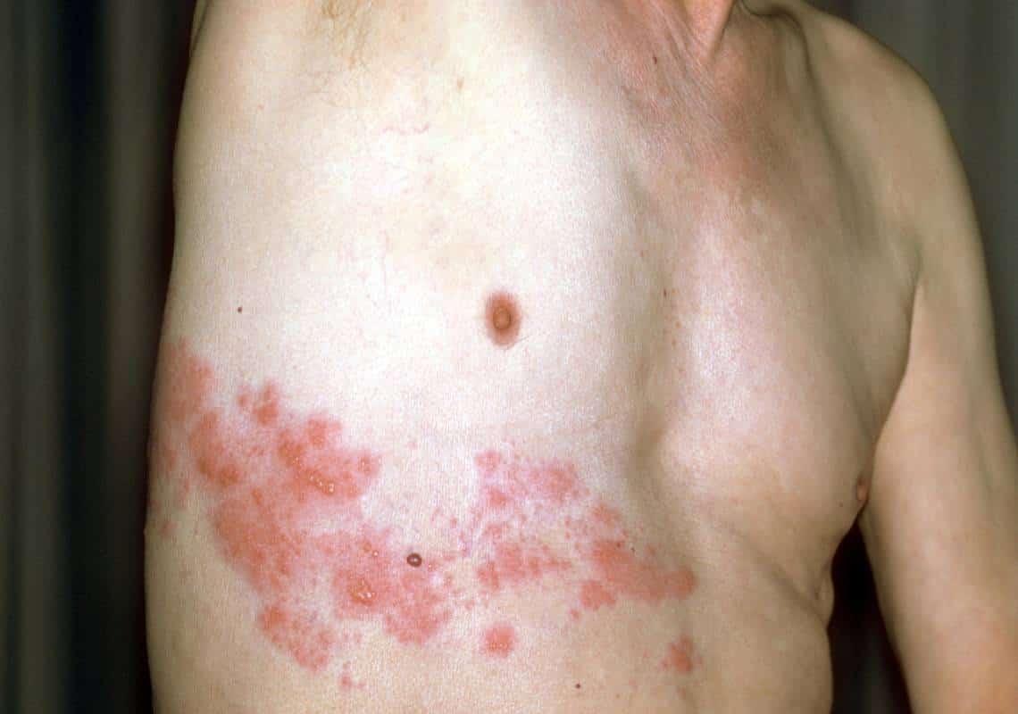 חוקרים ישראלים חוששים: "חיסון פייזר עלול לגרום במקרים נדירים להרפס-זוסטר"