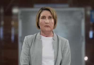 השתלת פנים ראשונה מסוגה בעולם: אישה מספרד קיבלה פנים חדשות מתורמת שבחרה למות בסיוע רפואי