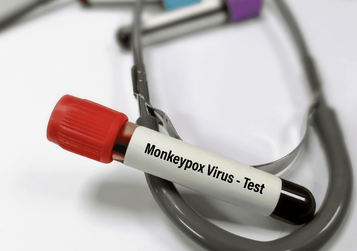 התפשטות אבעבועות הקופים: בינה מלאכותית תוכל לתת אבחון תוך שעה וחצי