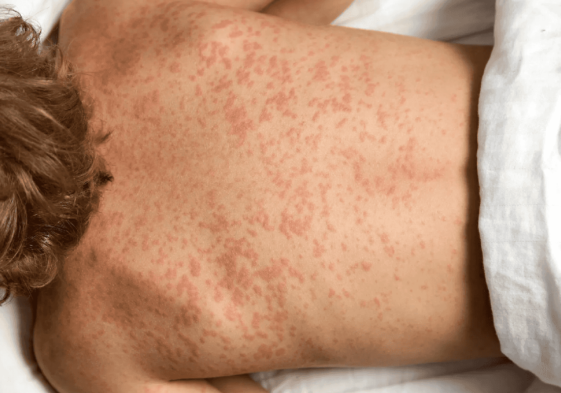 טקסס בבעיה: מקרי החצבת ממשיכים לזנק - בהתפרצות הקשה ביותר מזה שלושה עשורים