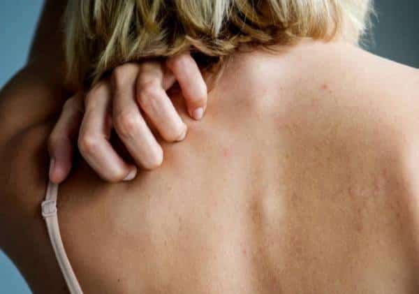 דרמטולוגים מזהירים : זהו התסמין המקדים המעורר חשש להידבקות עוד בטרם שיעול וחום