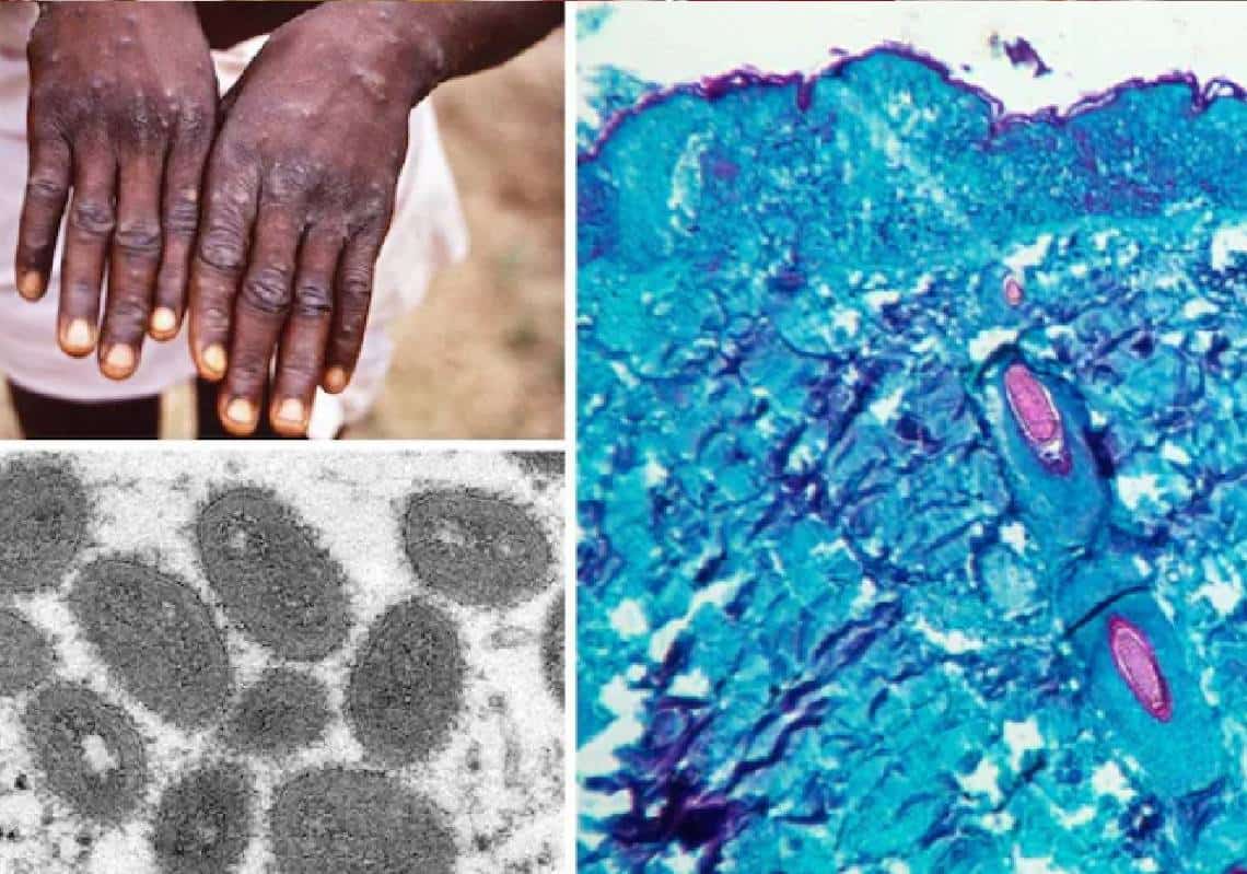 ארגון הבריאות העולמי מתכנס לישיבת חירום עם המשך הההתפרצות הגלובלית של אבעבועות הקופים