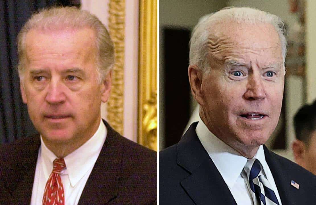 מנתח פלסטי בכיר חושף: "ביידן הוציא 100,000 דולרים על ניתוחים פלסטיים"