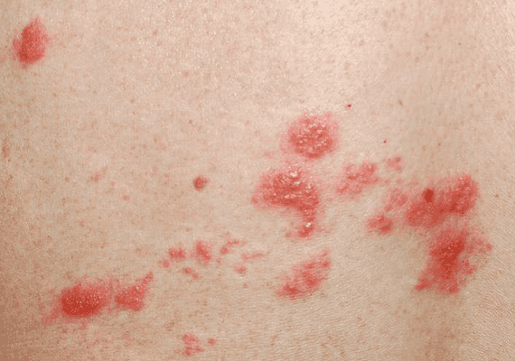 'אלרגיה או..': שני מצבים הגורמים לפריחה ודורשים התייחסות רפואית