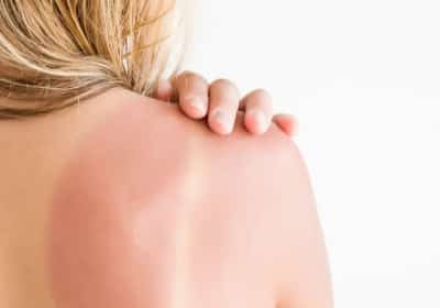 לא רק אלוורה: 3 דרכים מפתיעות לטיפול בכוויות שמש