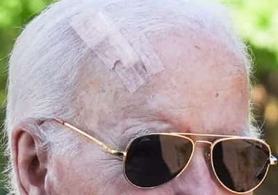 מה מסתתר מאחורי הצלקת הגדולה על מצחו של ביידן? ההליך הרפואי שמבטיח שיעורי ריפוי של 99%