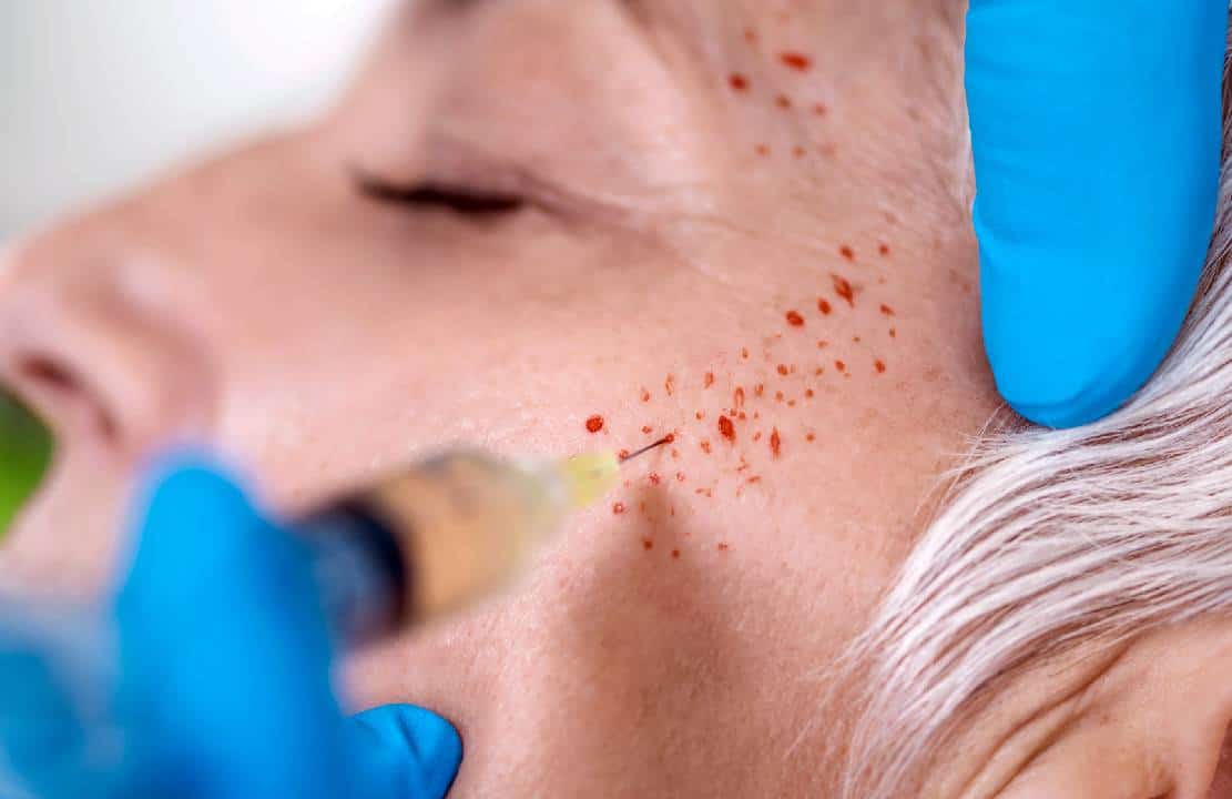 ה-CDC: "לראשונה בהיסטוריה 3 נשים נדבקו באיידס בשל הליך קוסמטי חדשני"