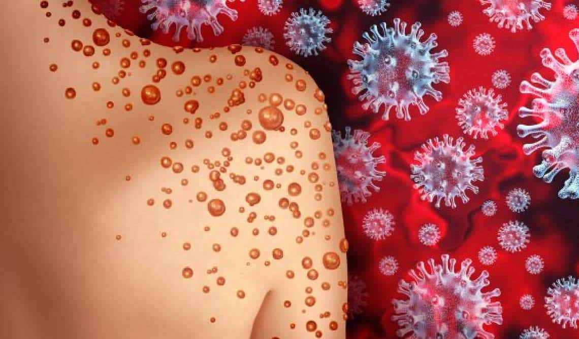 "המקרה הקשה ביותר": אפו של חולה באבעבועות הקופים נרקב לאחר שהרופא אמר לו בהתחלה שמדובר ב'כוויות שמש'