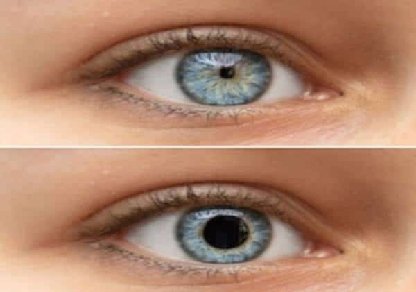 תגלית פורצת דרך: אישוני העיניים יכולים להעיד על פוסט-טראומה