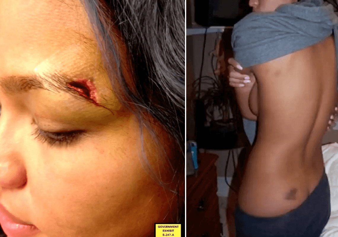 סימני אלימות קשים: תמונות מזעזעות נחשפות מעדותה של קאסי ונטורה נגד פאף דדי