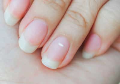 גם אתם בטוחים שכתמים לבנים על הציפורן מעידים על מחסור בסידן? אז זה הזמן לשבור את המיתוס