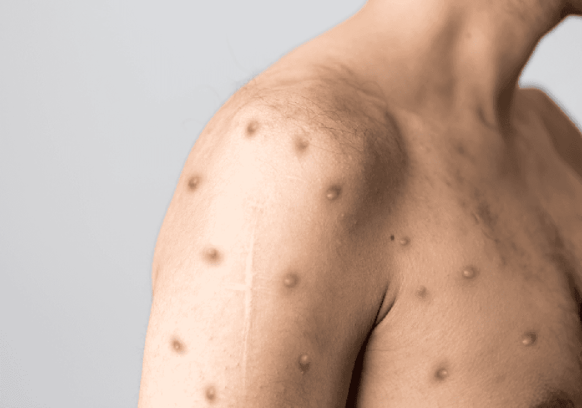 רשמית: ארה"ב רשמה את מקרה המוות הראשון מאבעבועות הקופים 