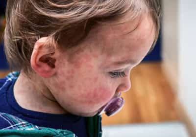 ארה"ב שוב נלחמת בחצבת: מומחים מזהירים שהנתונים הרשמיים “רק קצה הקרחון”