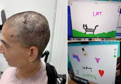 שתל מוחי מבית ניוראלינק של אילון מאסק איפשר למשותקת לכתוב ולצייר בכוח המחשב