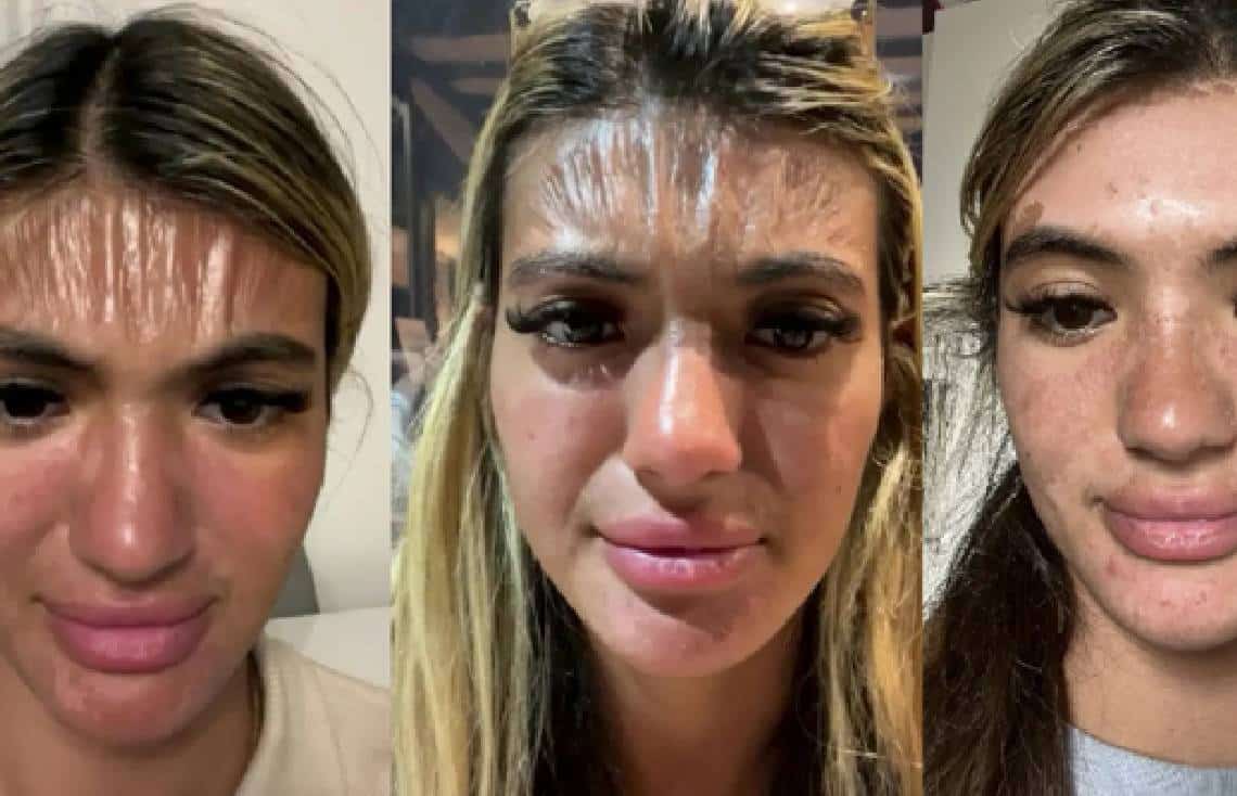 "פרצוף פלסטיק": הקוסמטיקאית השתזפה בשמש ונרדמה למשך חצי שעה - היא שילמה על כך ביוקר