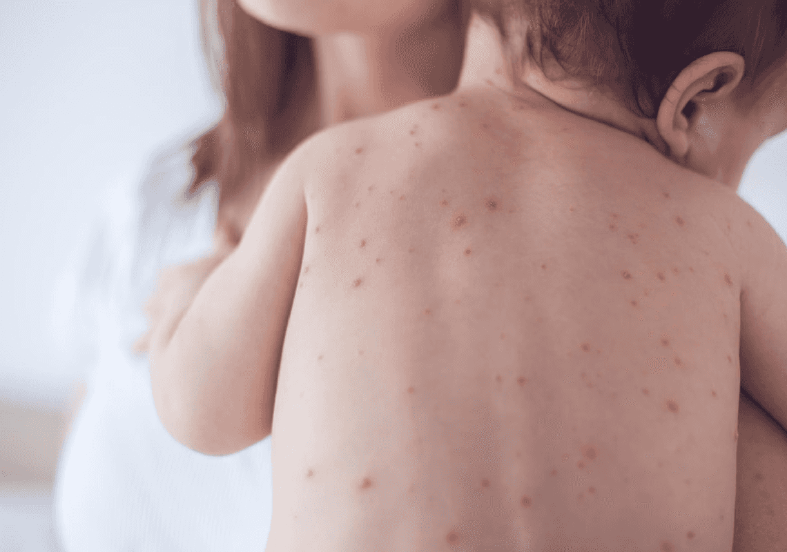 כמעט 1,000 חולי חצבת בארה"ב: האם חסינות העדר נפגעה?